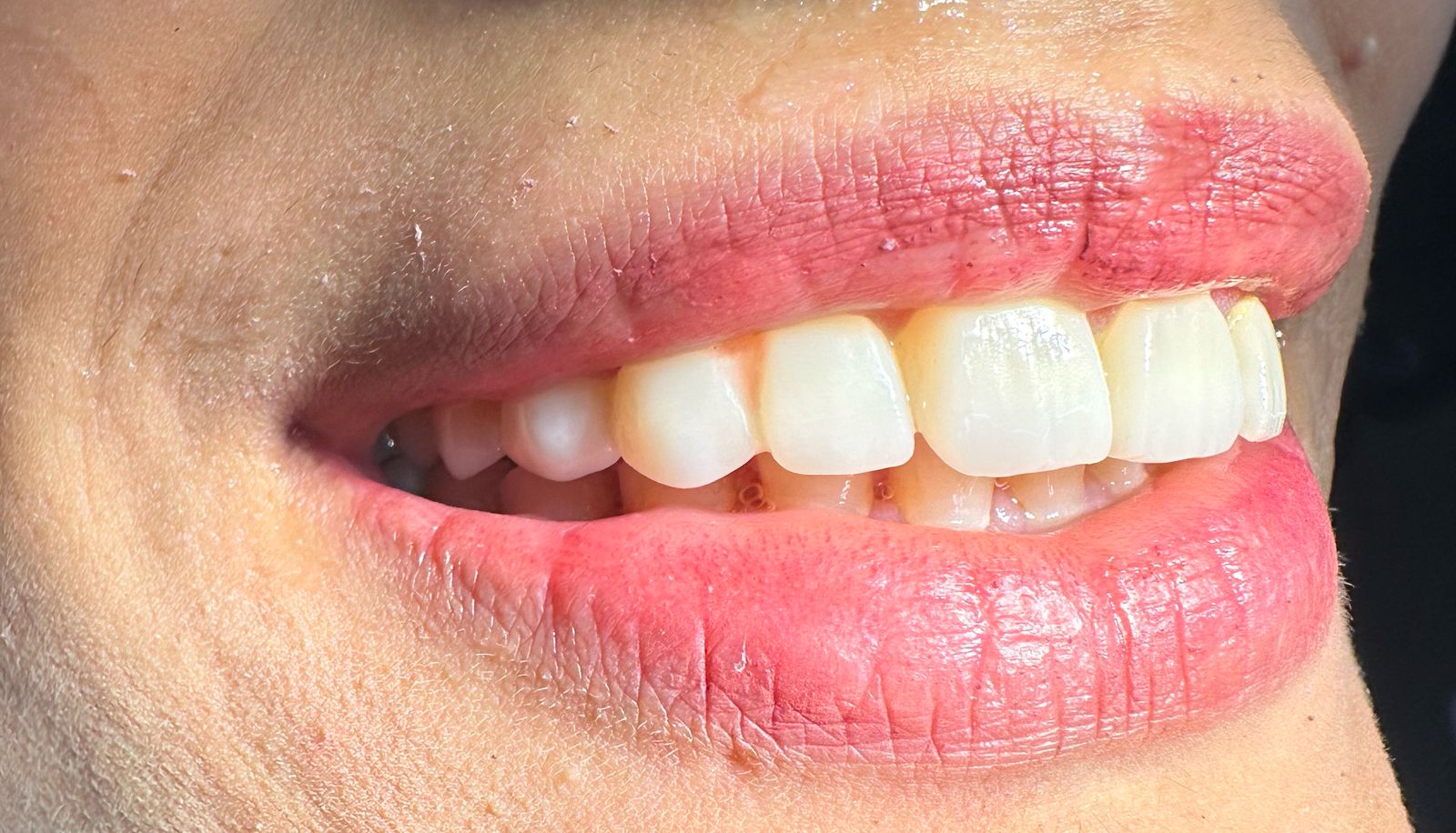 Dental Restoration Case 2