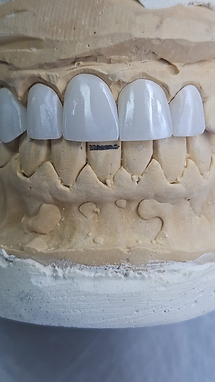 Dental Restoration Case 6