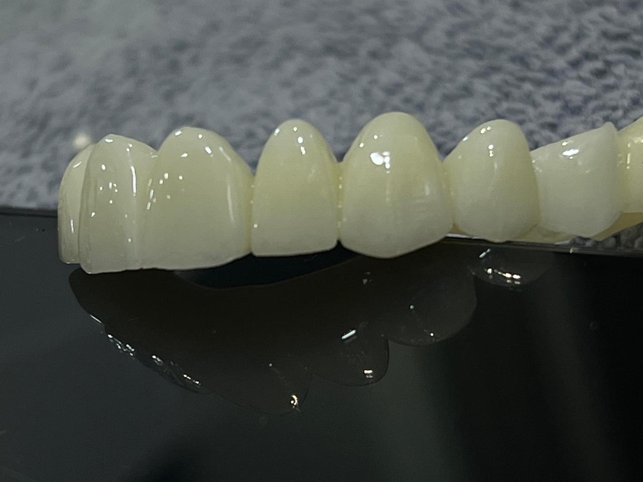 Dental Restoration Case 7